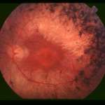 https://dev.dioptrija.hr/bolesti-oka/retinitis-pigmentosa-rp-sto-se-lijeci
