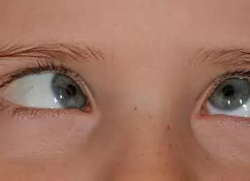Strabizam ili akomodacijska ezotropija- što je i kako se liječi?