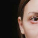 https://dev.dioptrija.hr/greske-oka/jecmenac-chalazion-uzroci-razlike