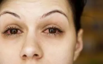 Konjuktivitis - vrste, uzroci, simptomi i liječenje