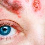 https://dev.dioptrija.hr/greske-oka/herpes-oka-uzroci-simptomi-lijecenje